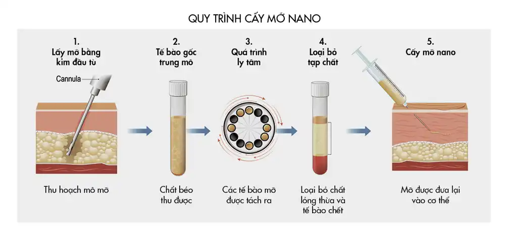 BEAUTY_TECHNIQUE_NANO_FAT_GRAFTING